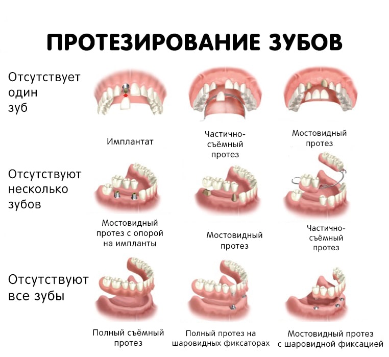 виды зубного протезирования